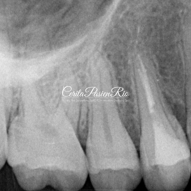 gambar . foto xray menunjukkan tepi marginal yang baik antara gutta percha, resin komposit, dan dentin. juga tampak badan (body) tambalan yang homogen.