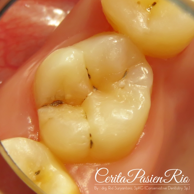 dokter gigi spesialis konservasi gigi terbaik di jakarta indonesia perawatan saluran akar tambalan resin komposit 1