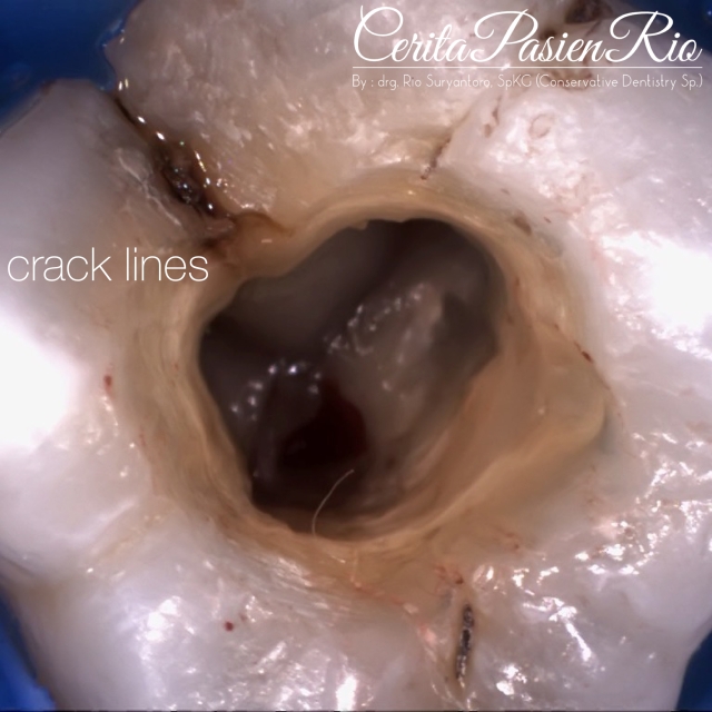 dokter gigi spesialis konservasi gigi terbaik di jakarta indonesia perawatan saluran akar tambalan resin komposit 4