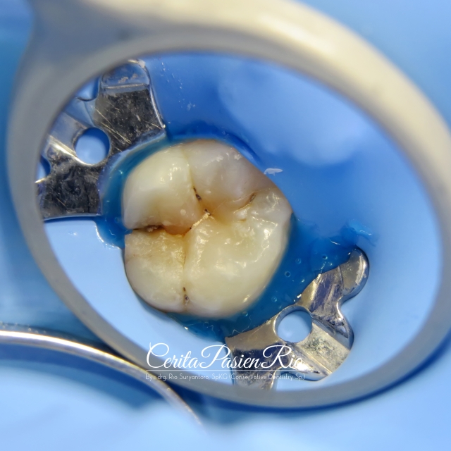dokter gigi spesialis kosnervasi gigi terbaik di jakarta lup 3