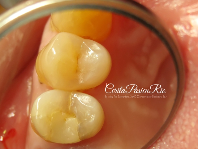 gambar 1. keadaan gigi secara klinis saat pertama kali datang.