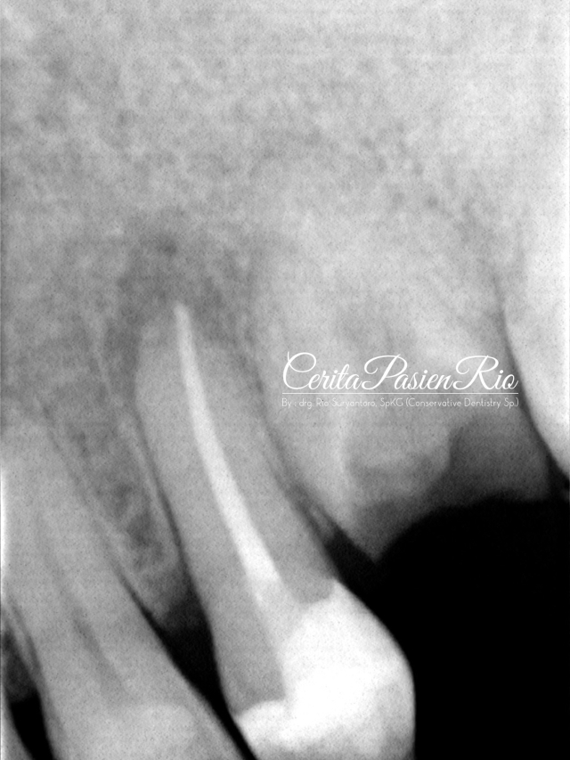 gambar 12. keadaan setelah dilakukan perawatan endodontik. tampak marginal integriti yang baik antara resin komposit - gutta percha - dentin.