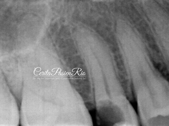 gambar 3. foto rontgent dental menunjukkan adanya kehilangan jaringan gigi yang cukup banyak dimulai dari bagian proksimal distal.