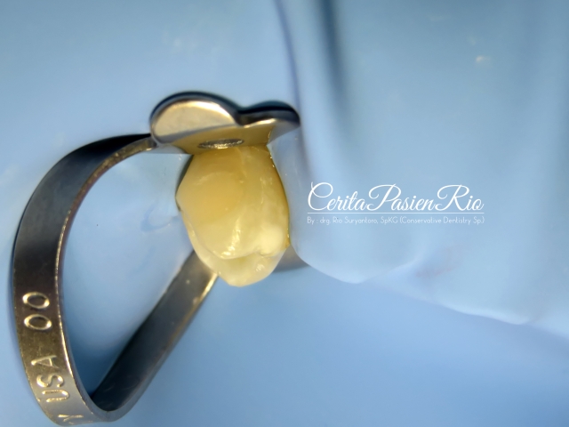 gambar 22. pemasangan isolasi pada gigi premolar dengan rubber dam (hu friedy rubberdam clamp dan nictone rubber dam sheet)
