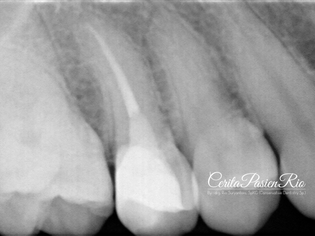 Gambar 27. evaluasi radiograf dengan foto xray dental yang dilakukan pasca penambalan. tampak integritas tepi resin komposit yang rapat dan homogenitas dari restorasinya yang padat.